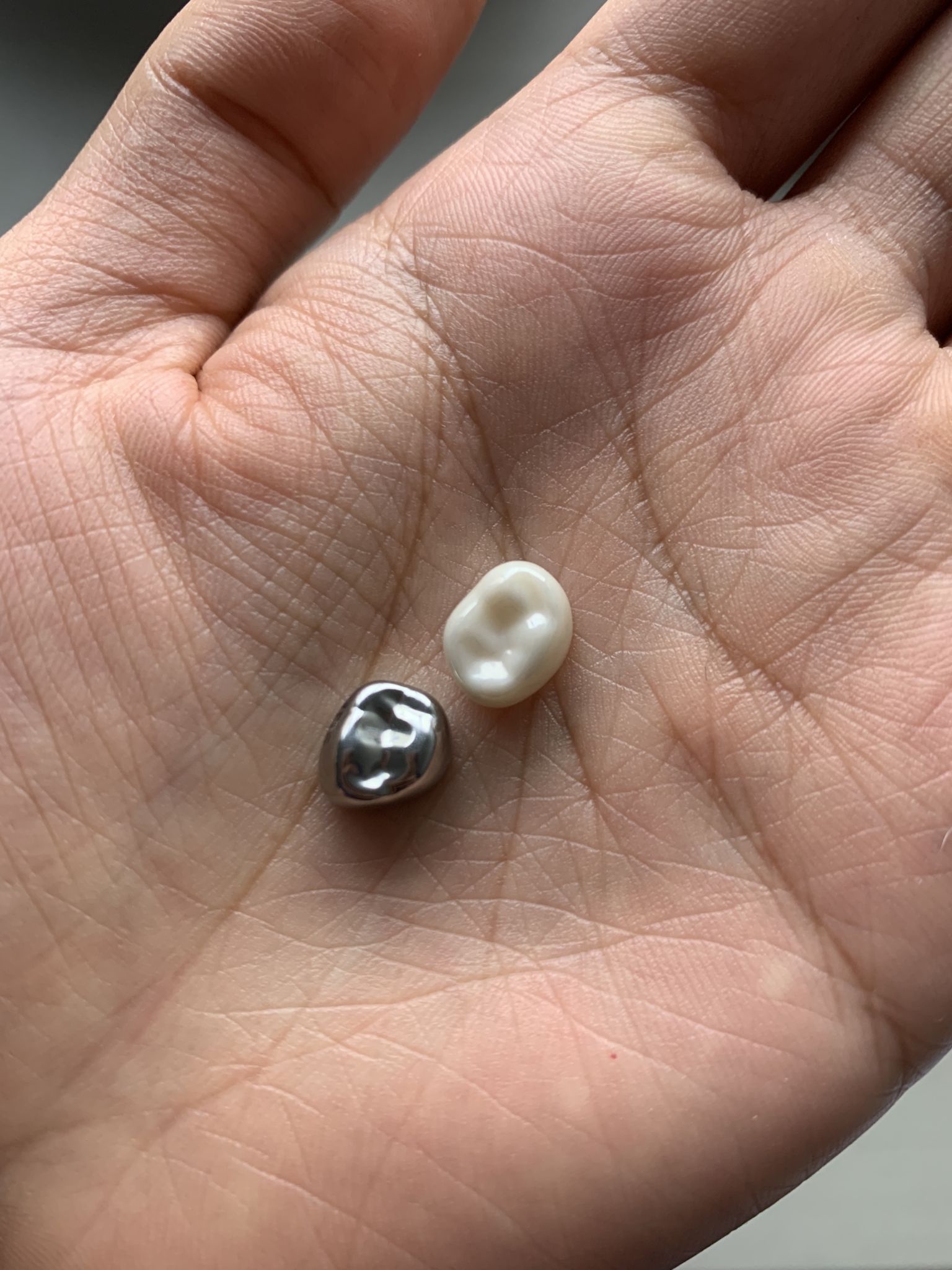 What is a children's dental crown and is there a difference between